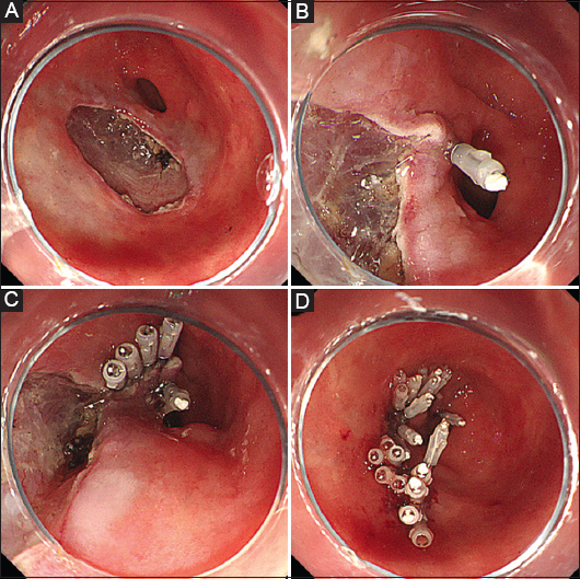 Endoscopic clip closure techniques used in the present study. a