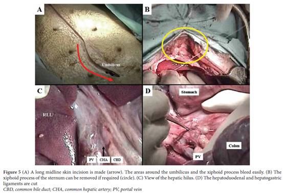 Donor operation