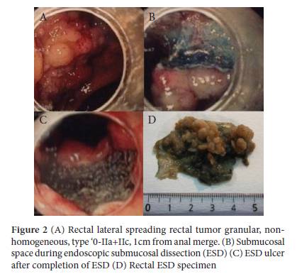 prognosis for stomach cancer inoperable