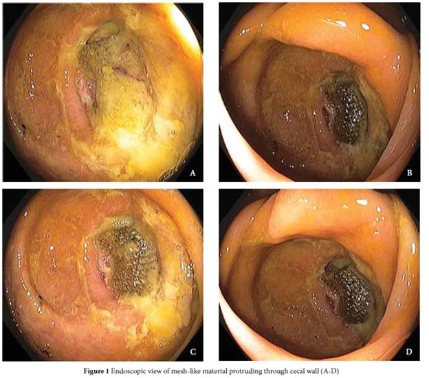 What are symptoms of problems with the mesh used in hernia surgery?